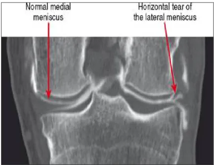 Figure 12:Image arthro-scanner du genou mettant en évidence une lésion méniscal