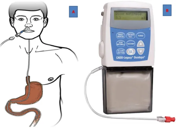 Figure 6 : Phase naso-duodénale : administration du gel de lévodopa par  sonde naso-gastrique (A)