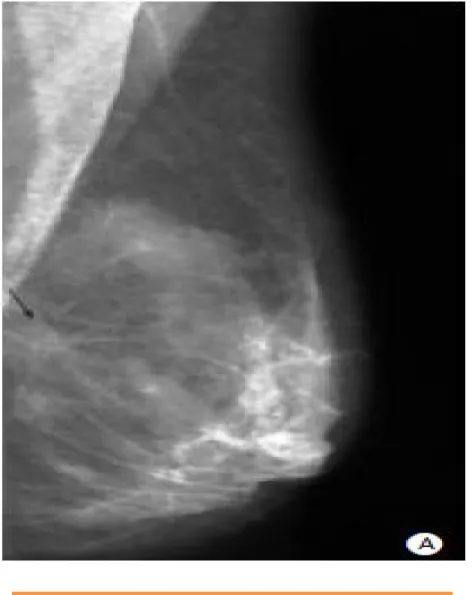 Figure 10: Mammographie. Opacité stellaire sans centre  dense. Dans ce cas clinique, l’histologie indiquera: 
