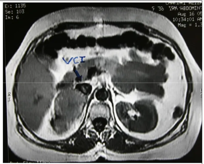 Fig 6 : IRM : Corticossurénalome avec thrombose de la veine cave inférieure 