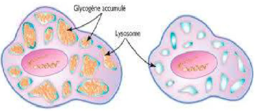 Figure 3:A gauche, une cellule malade dont les lysosomes sont chargés de glycogène accumulé