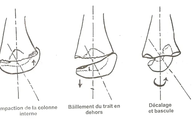 FIGURE 8 : les 3 types de varus résiduel (MARION et LAGRANGE)