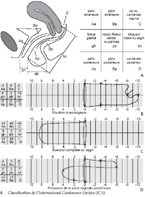 Figure 9 : classification de l’internationale continence society [28]. 