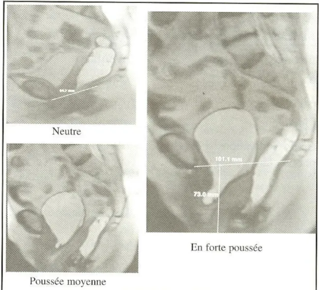 Figure 10 : aspect IRM de la cystocele en effort de  poussée 