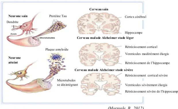 Figure 4 : présentation d’un neurone sain, d’un neurone atteint et des atrophies mises en évidence dans le  cerveau de malades d’Alzheimer 