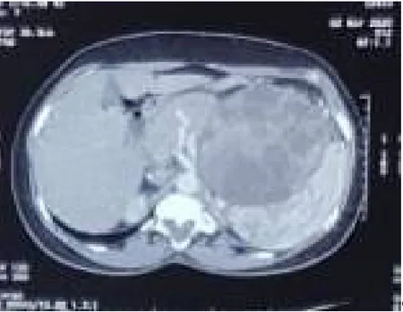 Figure 1 : Evoquant un kyste hydatique du pancréas ou une tumeur. 