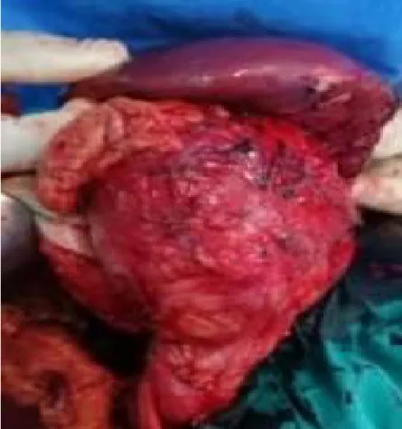 Figure 2 : Piece opératoire après une Spléno-pancréatectomie gauche   Sous anesthésie générale décubitus dorsal, billot sous les épines de l’omoplate ,  