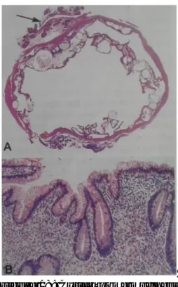 Figure 18: Cystadénome mucineux 