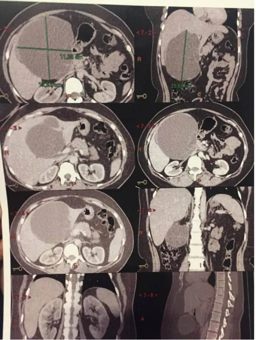 Figure 5 : TDM abdominale en coupe axiale montrant un aspect était   en faveur d’un kyste hydatique du foie stade III