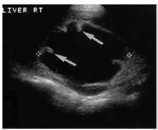 Figure  11 :  échographie  hépatique  chez  une  femme  de  43ans  avec  un  cystadénome  biliaire  qui montre un kyste anéchogène bien limité, à renforcement postérieur des échos