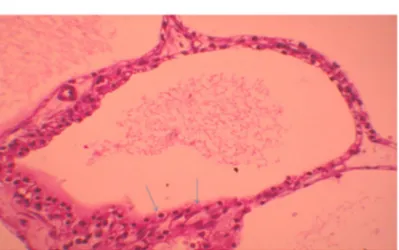 Figure 3: aspect microscopique de la tumeur 