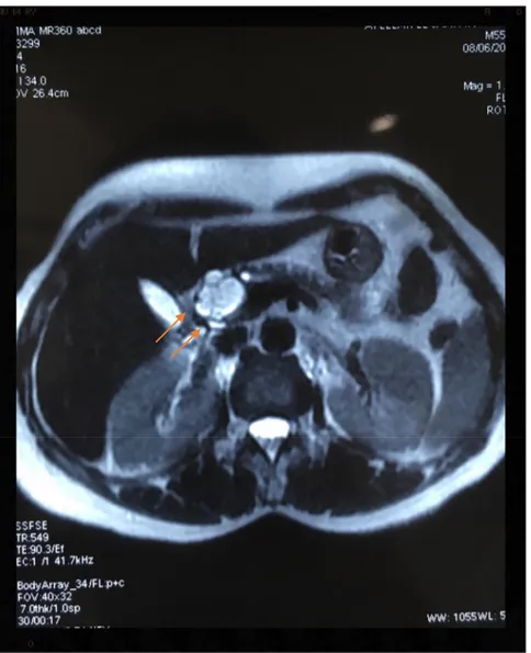 Figure 6: IRM abdominale, coupe axiale en T2 montrant la tumeur en  hypersignal. 