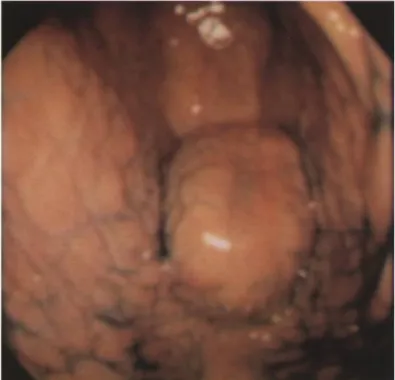 Figure 14: Image endoscopique d'un cancer gastrique d'aspect bourgeonnant au niveau  de la grande courbure antrale