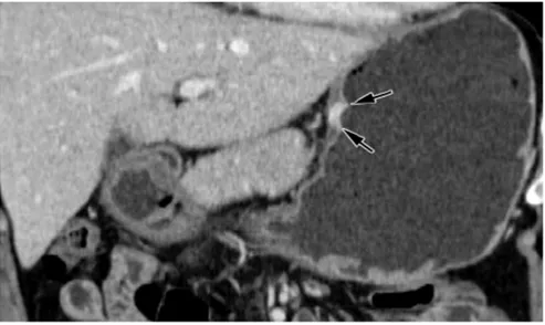 Figure 16: Image coronale montre une tumeur T1 avec rehaussement focal non  transmural dans le haut du corps