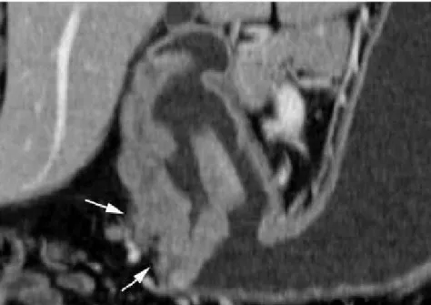 Figure 17: Image coronale montre une tumeur T3, avec infiltration grossière du tissu  adipeux périgastrique de l’antre