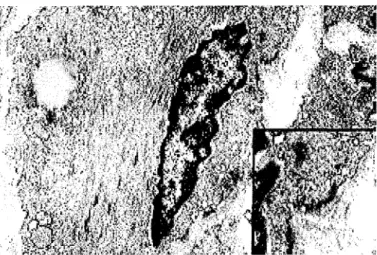 Fig. 6  :  Microscopie électronique  :  cellule sarcomateuse  avec présence  de filaments  cytoplasmiques avec des condensations  à  la gauche du noyau, un corps de lipide  à  l'extrême  gauche de ce noyau, et des vésicules de pinocytose  à  droite de ce n