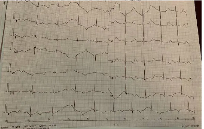 Figure 5 : ECG pathognomonique d’un syndrome du QT long avec un QTc mesuré à  680ms de l’enfant atteint du syndrome de Jervell et Lange Nielson 