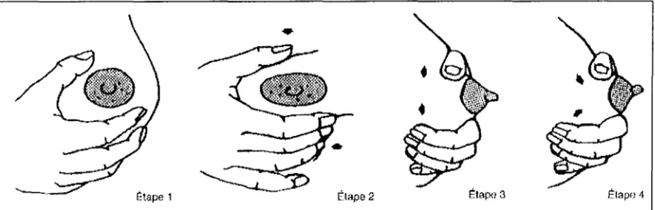 Figure 6 : Technique du « mamelon en sandwich» {10}