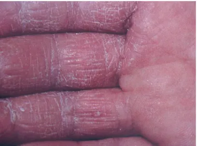 Figure 4: Dermites des mains par des irritants (46) 