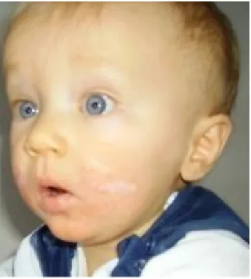 Figure 6 : Nourrisson atteint d’une dermatite atopique (48)  Chez l’enfant : 