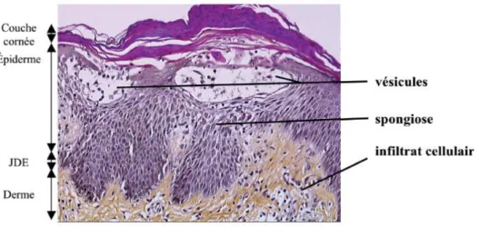 Figure 9 : Coupe histologique caractéristique de peau atteinte de dermatite  allergique de contact :(Coloration hématoxilline et éosine) 