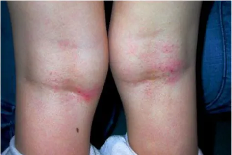 Figure 3 : Dermatite atopique des plis des genoux chez un enfant 