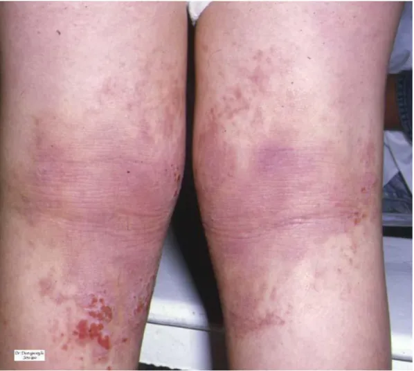 Fig3 : Dermatite atopique de l’enfant : eczéma lichénifié  