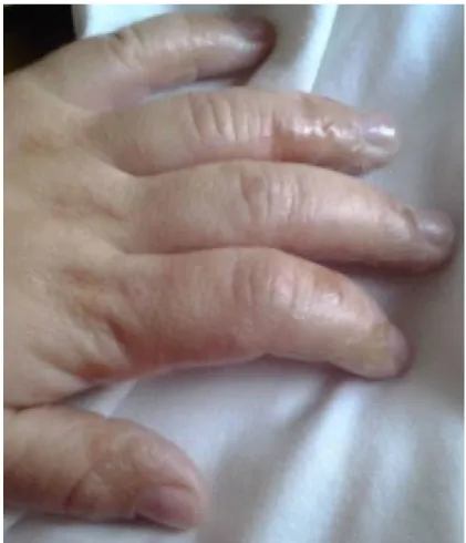 Figure 18 : dermatite herpétiforme : vésicule et gonflement dans les mains (168) 
