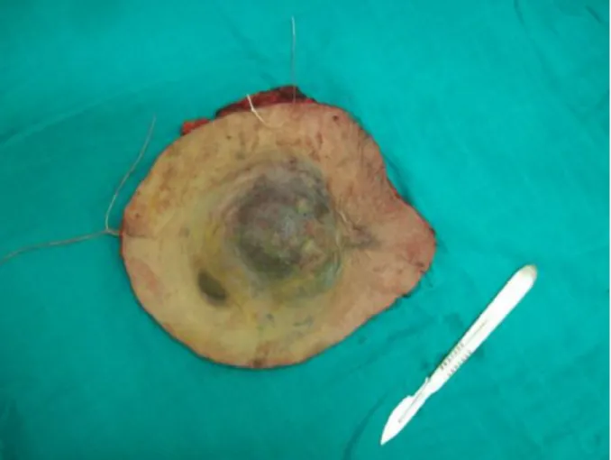 Figure 11 : pièce de résection de DFS récidivant de la face antérieure du thorax passant  à plus de 5 cm de la tumeur 