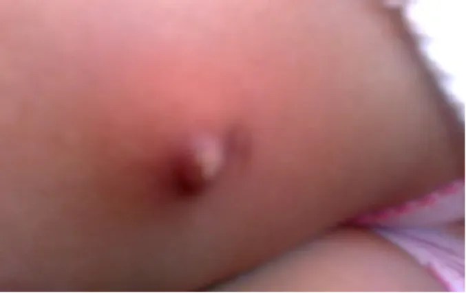 Figure 11 :calcinose de la face postérieure de la cuisse gauche 