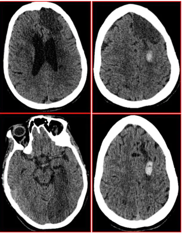 Figure 3 : Images TDM cérébrale 