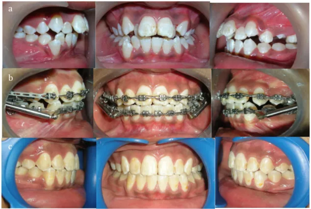 Figure 1: a:   Photographies   intra-­‐buccales   avant   traitement,   b:   en   cours   et   c:   2ans   après   traitement    orthodontique