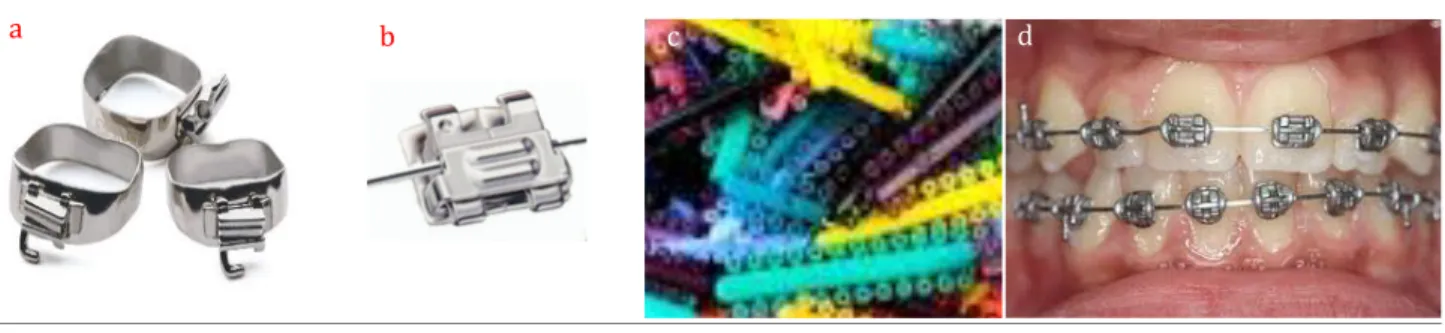 Figure 2: a: Bagues, b: Bracket autoligaturant, c: Ligatures élastomériques de couleur variées et d: Appareillage  orthodontique en bouche