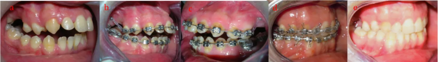 Figure 13: Utilisation   de   la   chaînette   élastomérique   pour   ingresser   des   dents   postérieures   :   a:   photo   de    début   de   traitement;   b, c   et   d:   la   mise   en   place   d’une   chaînette   entre   la   minivis   et   la   