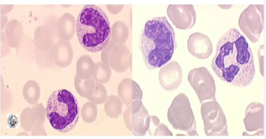 Figure 6 : Métamyélocyte moelle normale (9) 