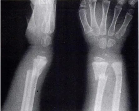 Figure n°15 : fracture métaphysaire complète des deux os de l’avant-bras [21] 