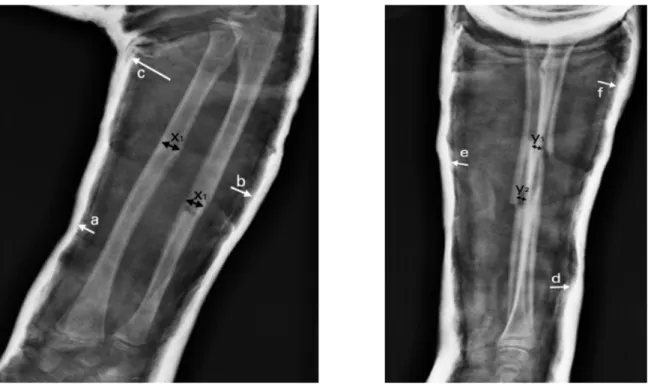 Figure n°19 : Three point index pour les fractures diaphysaires 