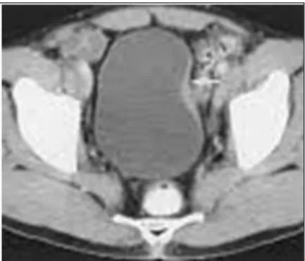 Figure L n°4 : une tumeur infiltrant la paroi musculaire de la face latérale gauche de la  vessie [47]