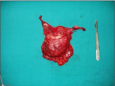 Figure  n°4a : pièce opératoire d’une pelvectomie antérieure fermé 