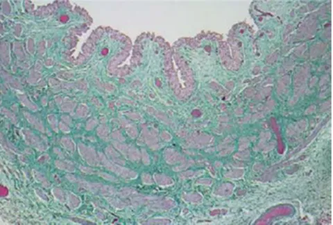 Figure 7: coupe histologique du segment apéristaltique d’un méga-uretère  [34] 