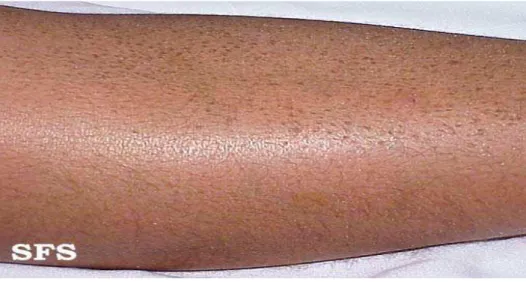Figure 16: Ichtyose vulgaire de la jambe [88] 