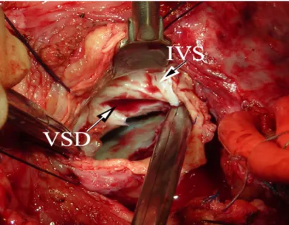 Figure 22: photo après explantation de la PVL mitrale et montrant un defect du septum  ventriculaire gauche [36]