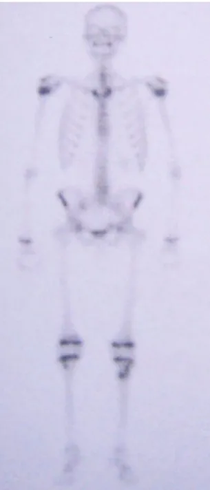 Figure  12 : Au temps tardif : Une hyperfixation Punctiforme intense en regard du tiers  supérieur du tibia gauche