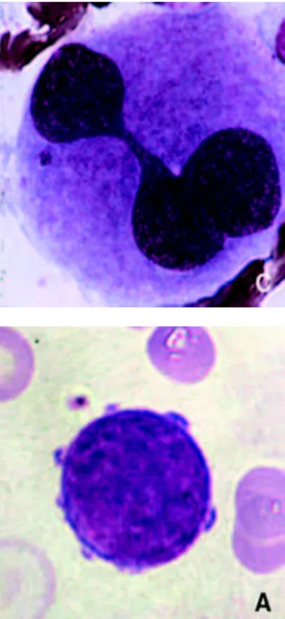 Figure 1: Différents stades de maturation des mégacaryocytes de moelle colorée au May- May-Grünwald-Giemsa.[17 