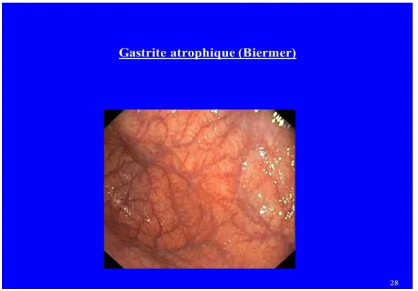 Figure 8 :Gastrite atrophique au cours de la maladie de Biermer(40) 