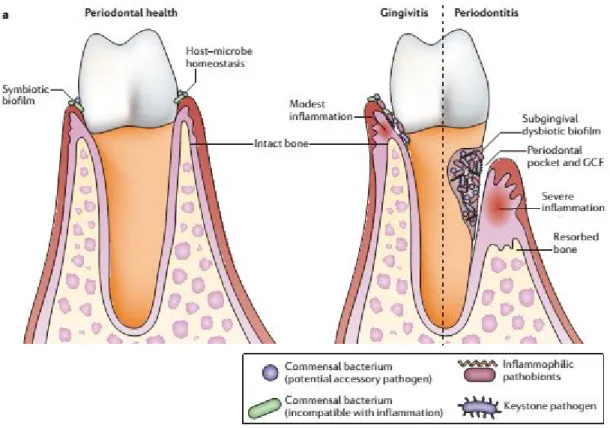 Figure 13 : Dysbiose dans la parodontite [57]. 
