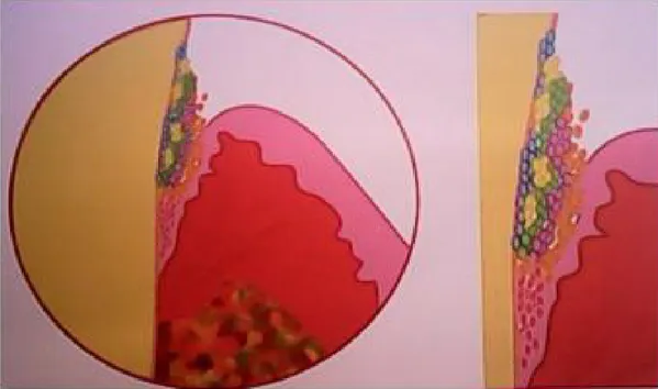 Figure 5: Biofilm supra et sous-gingival selon les complexes bactériens [29]. 