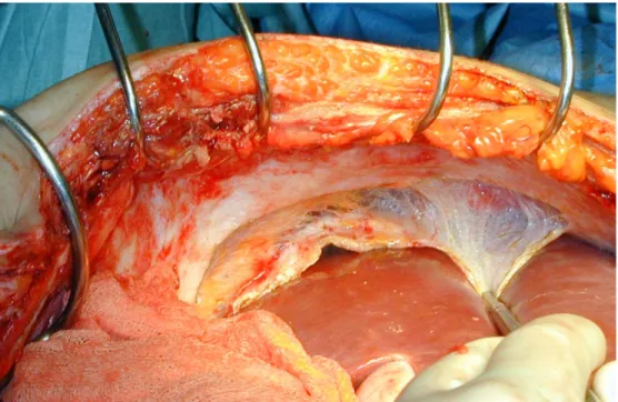 Figure 2 : Le péritoine : isolement péritonéal lors d’un abord chirurgical par voie   sous costale droite 