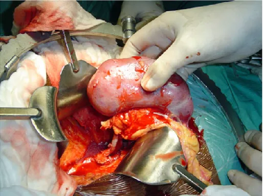 Figure 11 : greffon rénal lors d’une transplantation. 