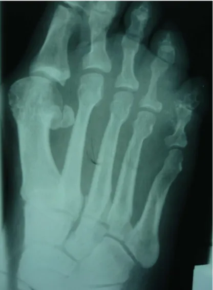 Figure 2 : Radiographie du pied gauche montrant une déminéralisation osseuse  et un hallux valgus